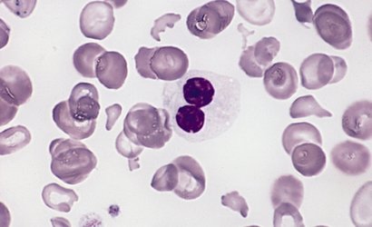 MDS cells under a microscope